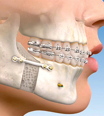 Cirurgia Ortognática