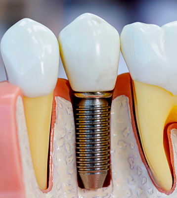 Implantes Dentários