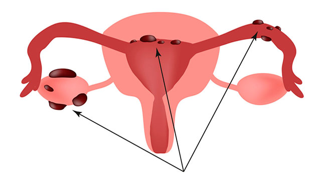 Endometriose com invasão intestinal