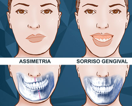 Assimetria e Sorriso Gengival