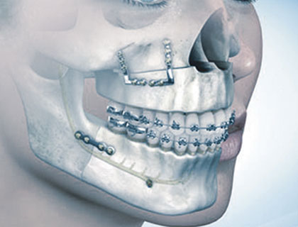 Miniplastas Cirurgia Ortognática
