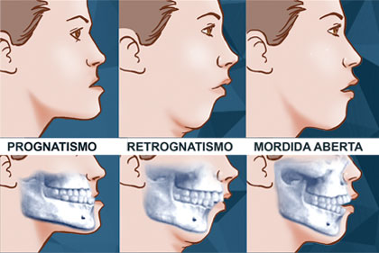 Prognatismo, Retrognatismo e Mordida Aberta