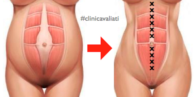 Abdominoplastia