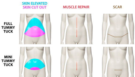Abdominoplastia