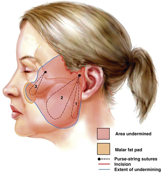 Face Lift