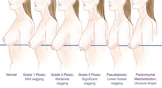 Mamoplastia