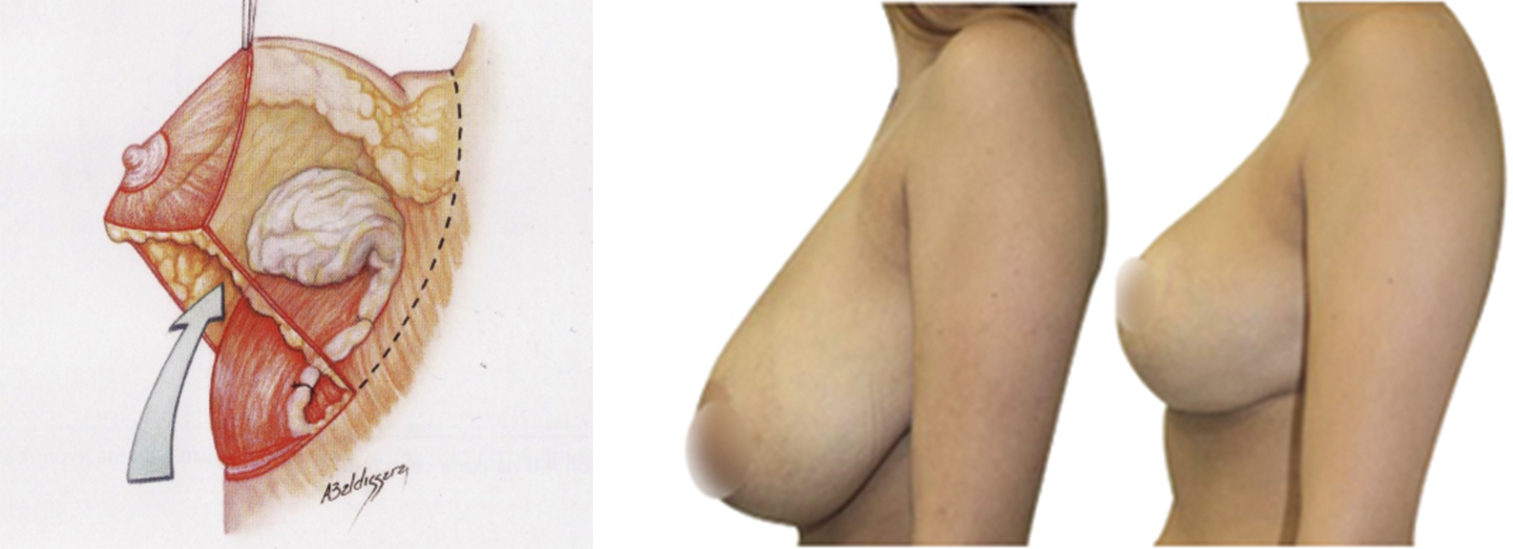 Mamoplastia